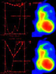 Nadroparine calcium or enoxaparine n acute coronary síndrome patients suffering renal insufficiency: The nadroparin versus enoxaparin (NaVe) study design